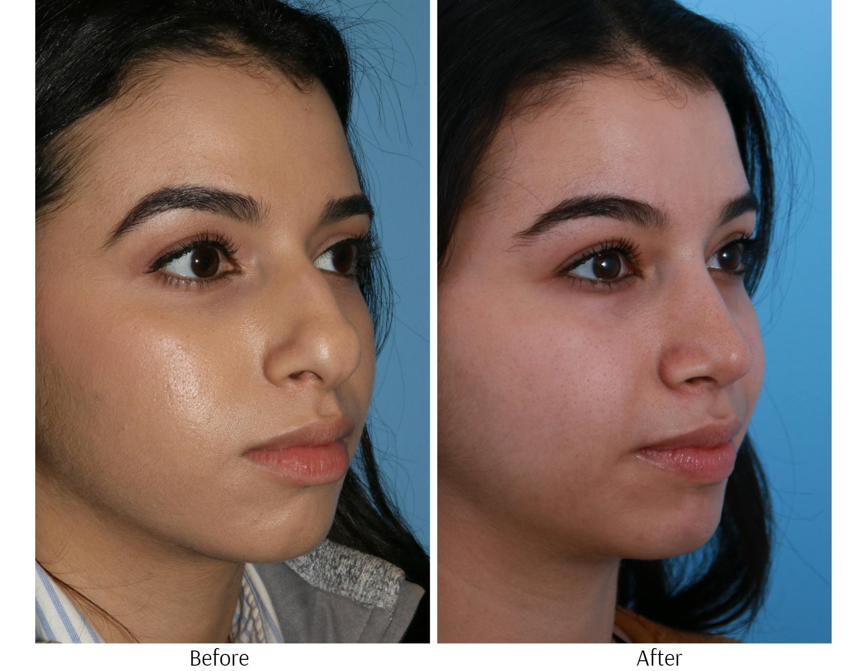 Rhinoplasty Before & After Gallery - Patient 64080957 - Image 5