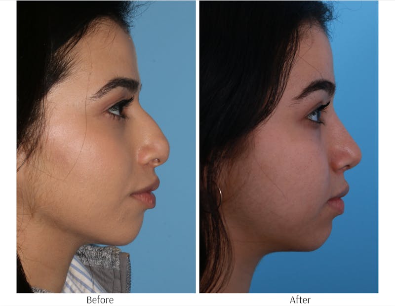 Rhinoplasty Before & After Gallery - Patient 64080957 - Image 1