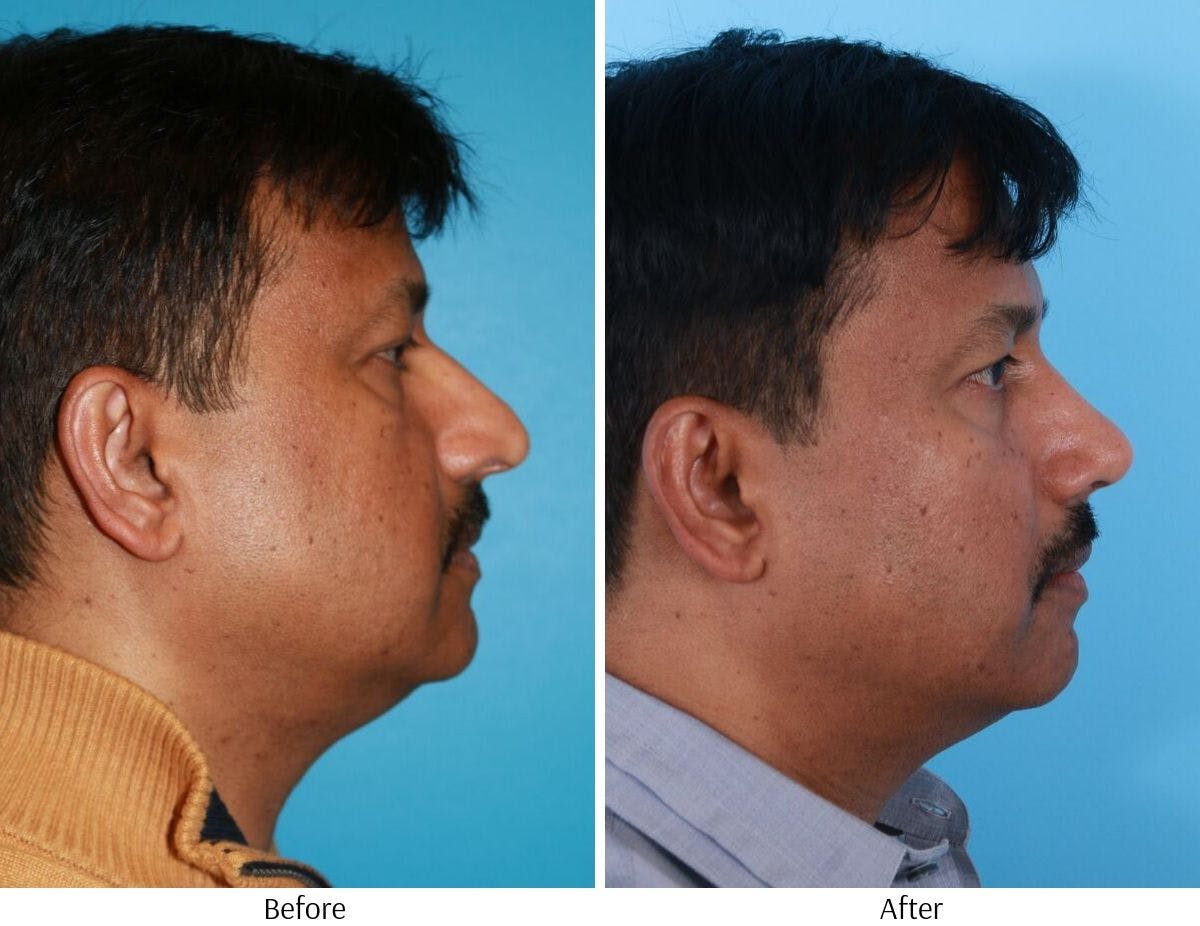 Rhinoplasty Before & After Gallery - Patient 64080958 - Image 5