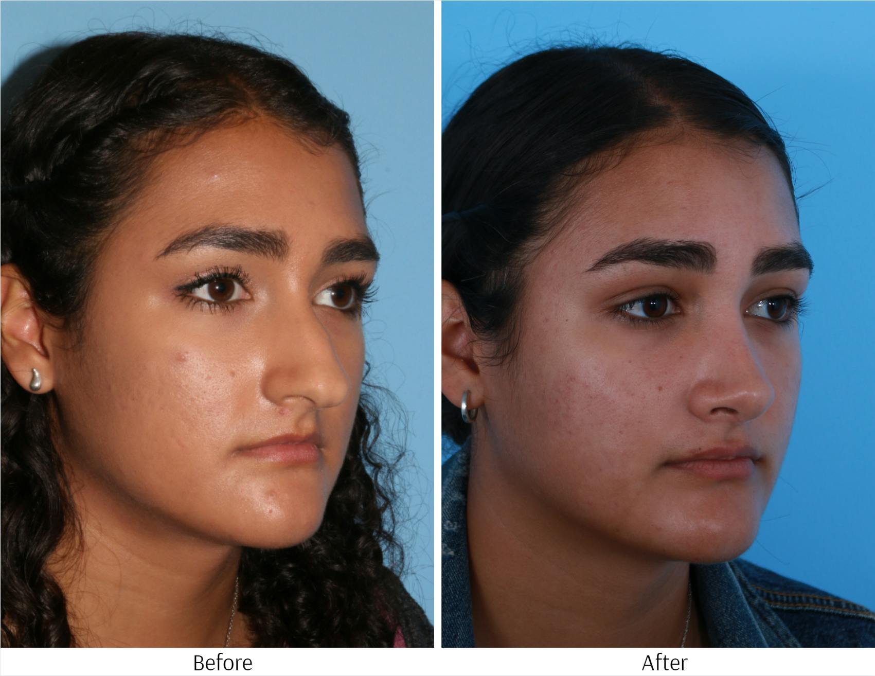 Rhinoplasty Before & After Gallery - Patient 64080987 - Image 6