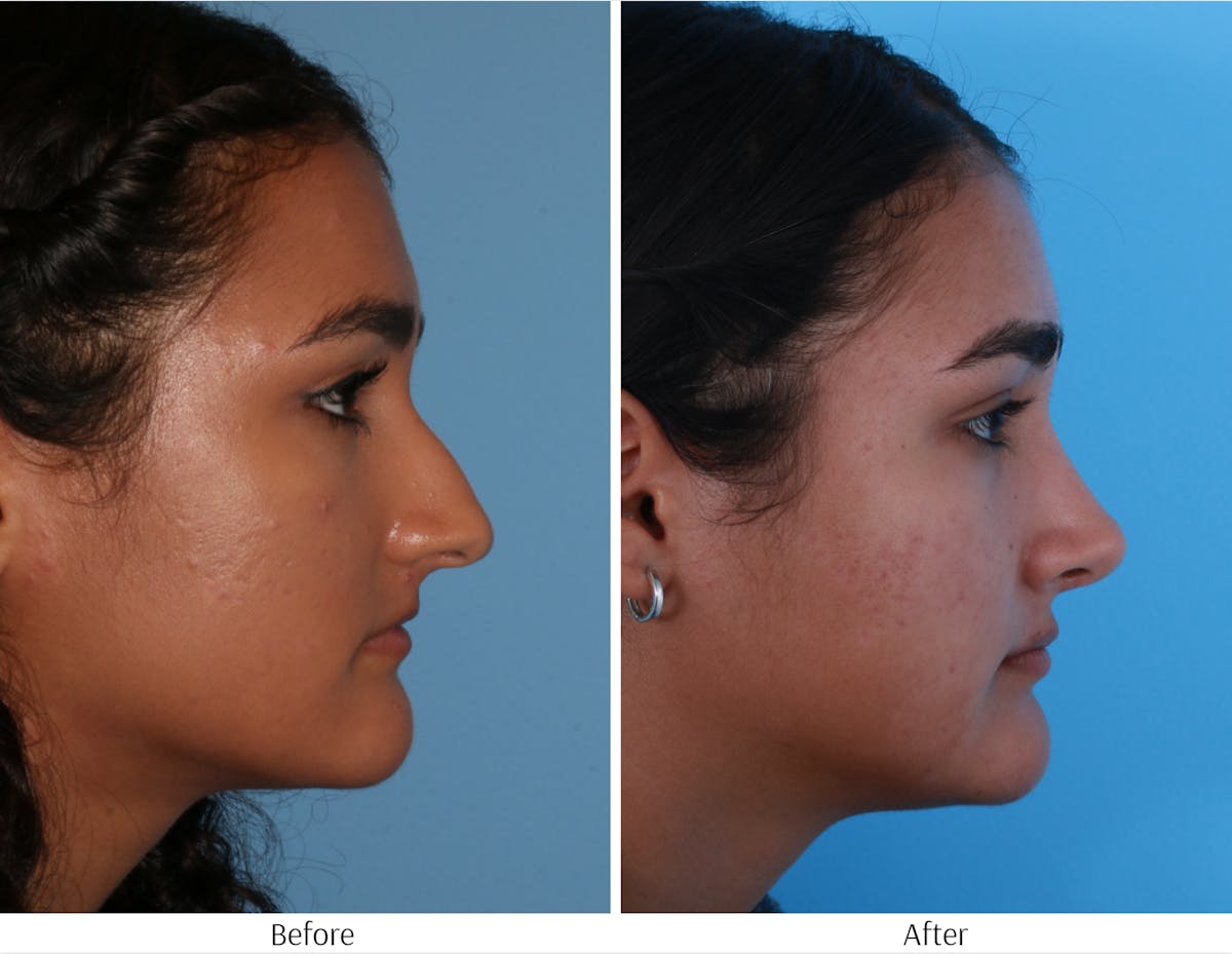Rhinoplasty Before & After Gallery - Patient 64080987 - Image 5