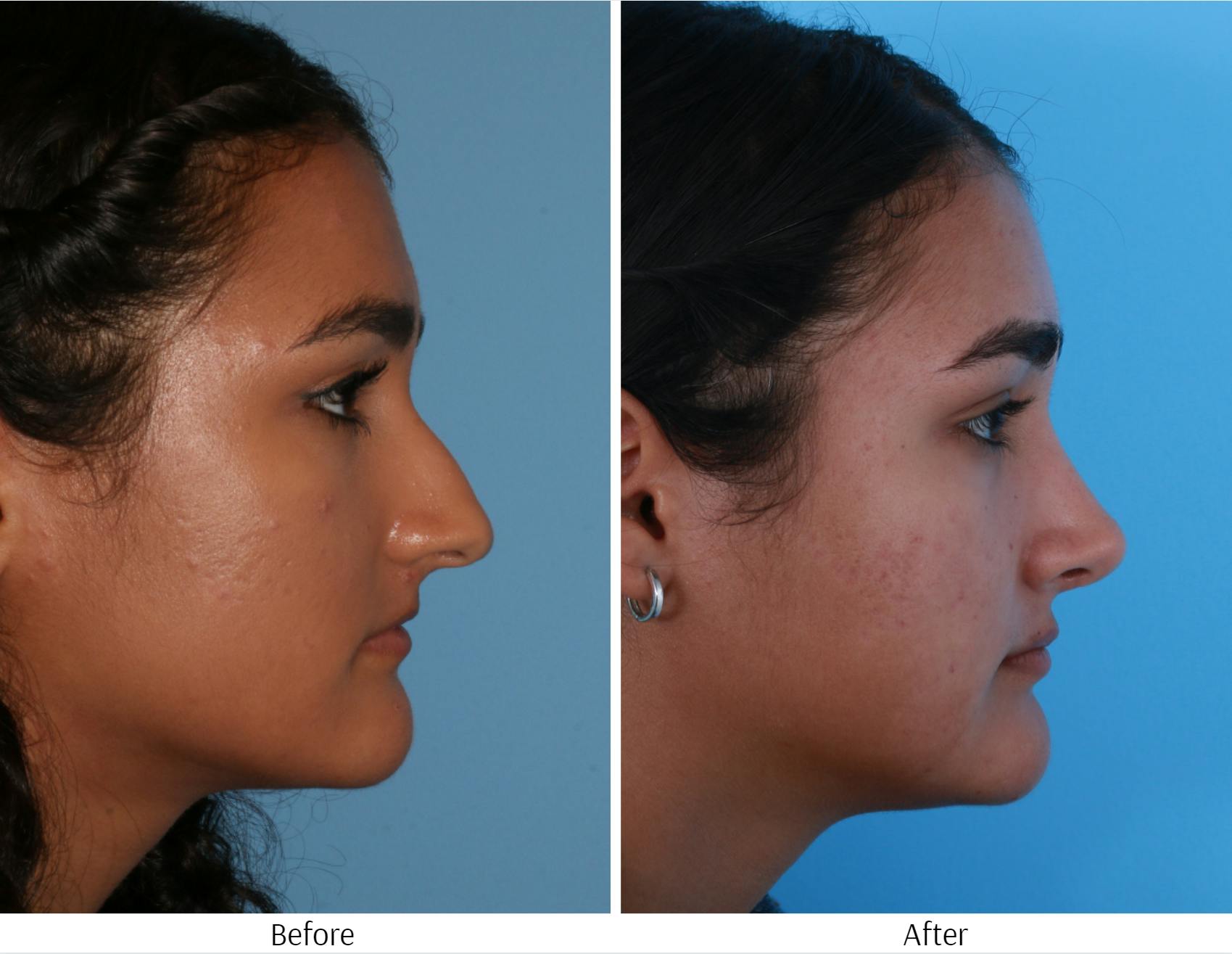 Rhinoplasty Before & After Gallery - Patient 64080987 - Image 5