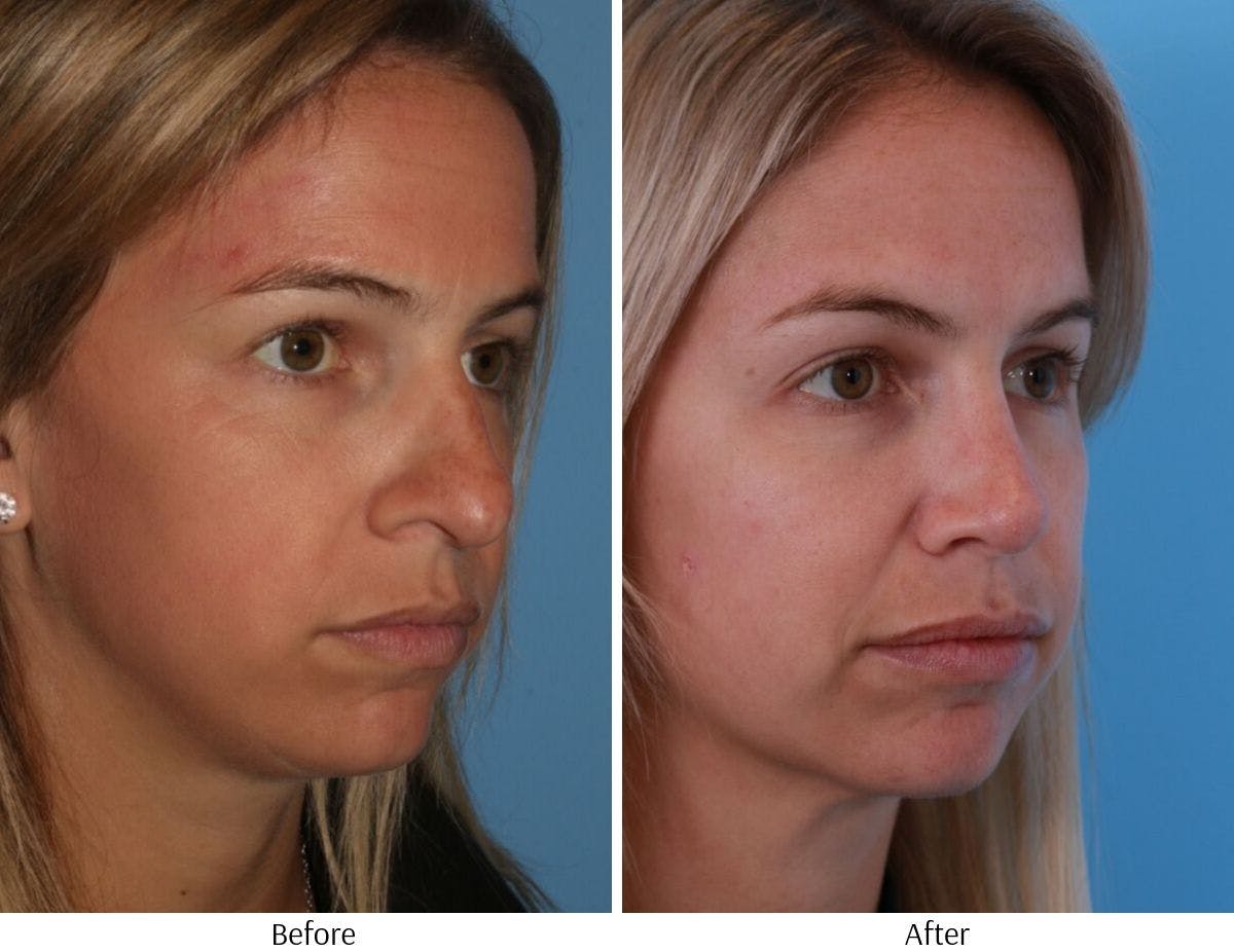 Rhinoplasty Before & After Gallery - Patient 64081020 - Image 2