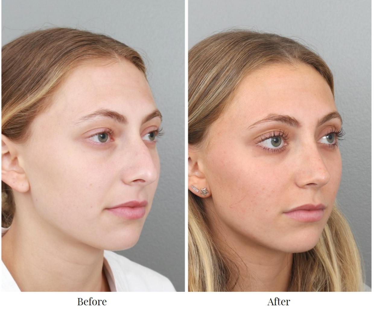 Rhinoplasty Before & After Gallery - Patient 64080943 - Image 3