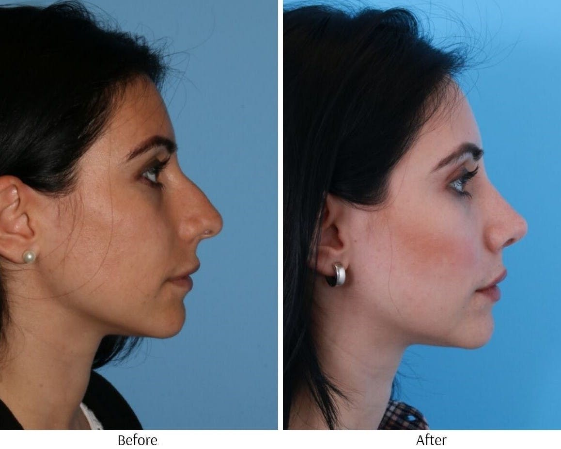Rhinoplasty Before & After Gallery - Patient 64080946 - Image 2