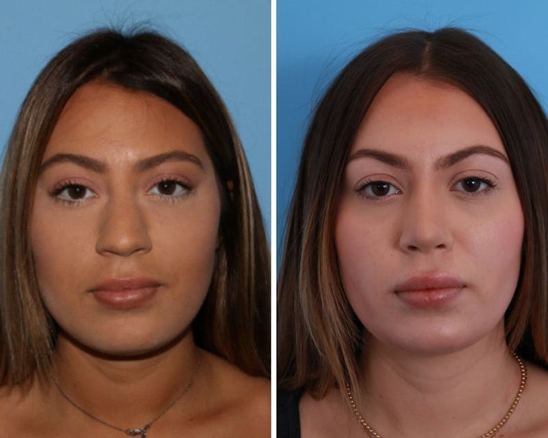 Rhinoplasty Before & After Gallery - Patient 64080944 - Image 1