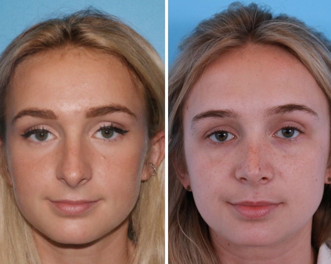 Rhinoplasty Before & After Gallery - Patient 64080945 - Image 1