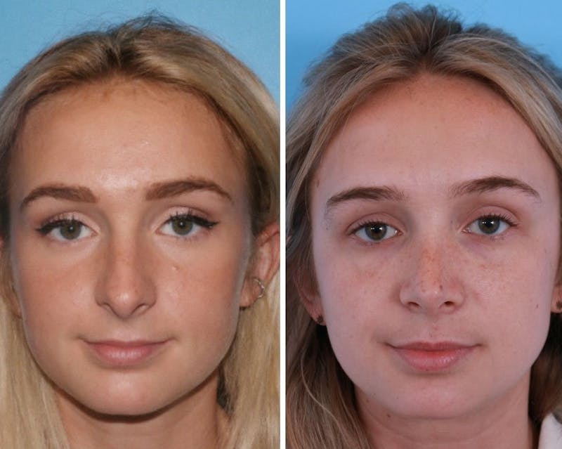 Rhinoplasty Before & After Gallery - Patient 64080945 - Image 1
