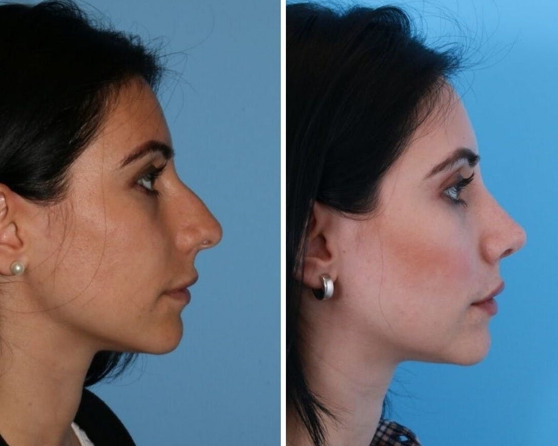 Rhinoplasty Before & After Gallery - Patient 64080946 - Image 1