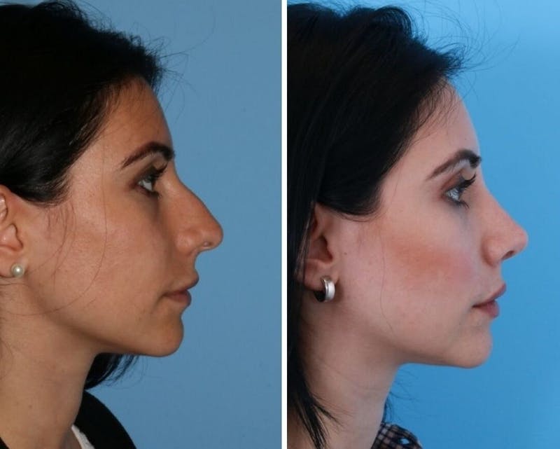 Rhinoplasty Before & After Gallery - Patient 64080946 - Image 1