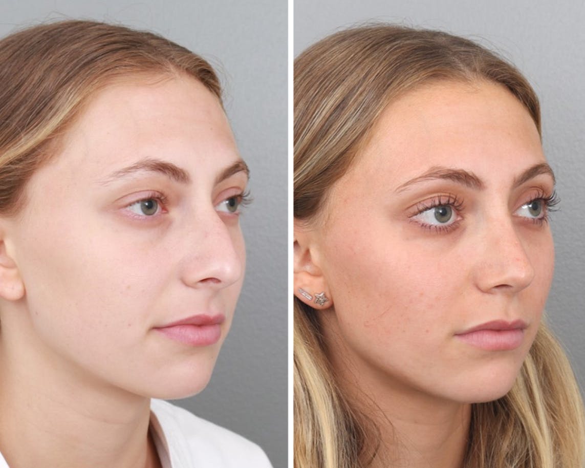 Rhinoplasty Before & After Gallery - Patient 64080943 - Image 1