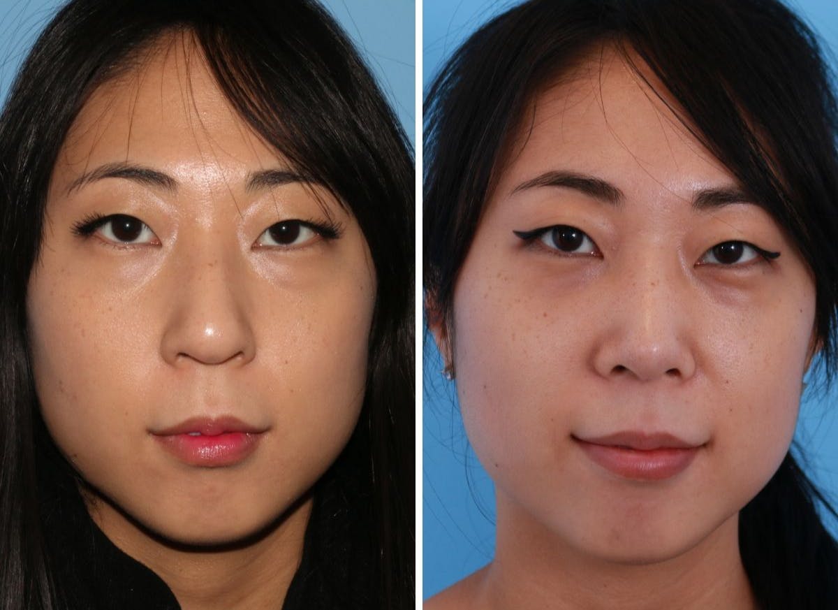 Rhinoplasty Before & After Gallery - Patient 64080953 - Image 6