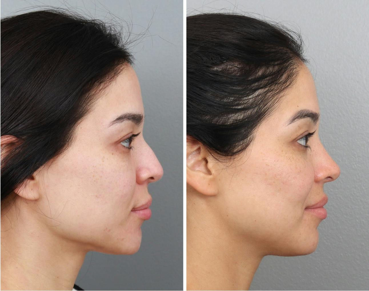 Rhinoplasty Before & After Gallery - Patient 64080954 - Image 5