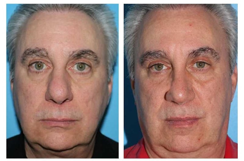 Rhinoplasty Before & After Gallery - Patient 64081085 - Image 1
