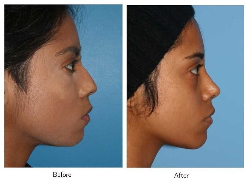 Rhinoplasty Before & After Gallery - Patient 64081070 - Image 1