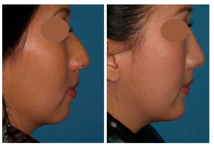 Rhinoplasty Before & After Gallery - Patient 64081029 - Image 3