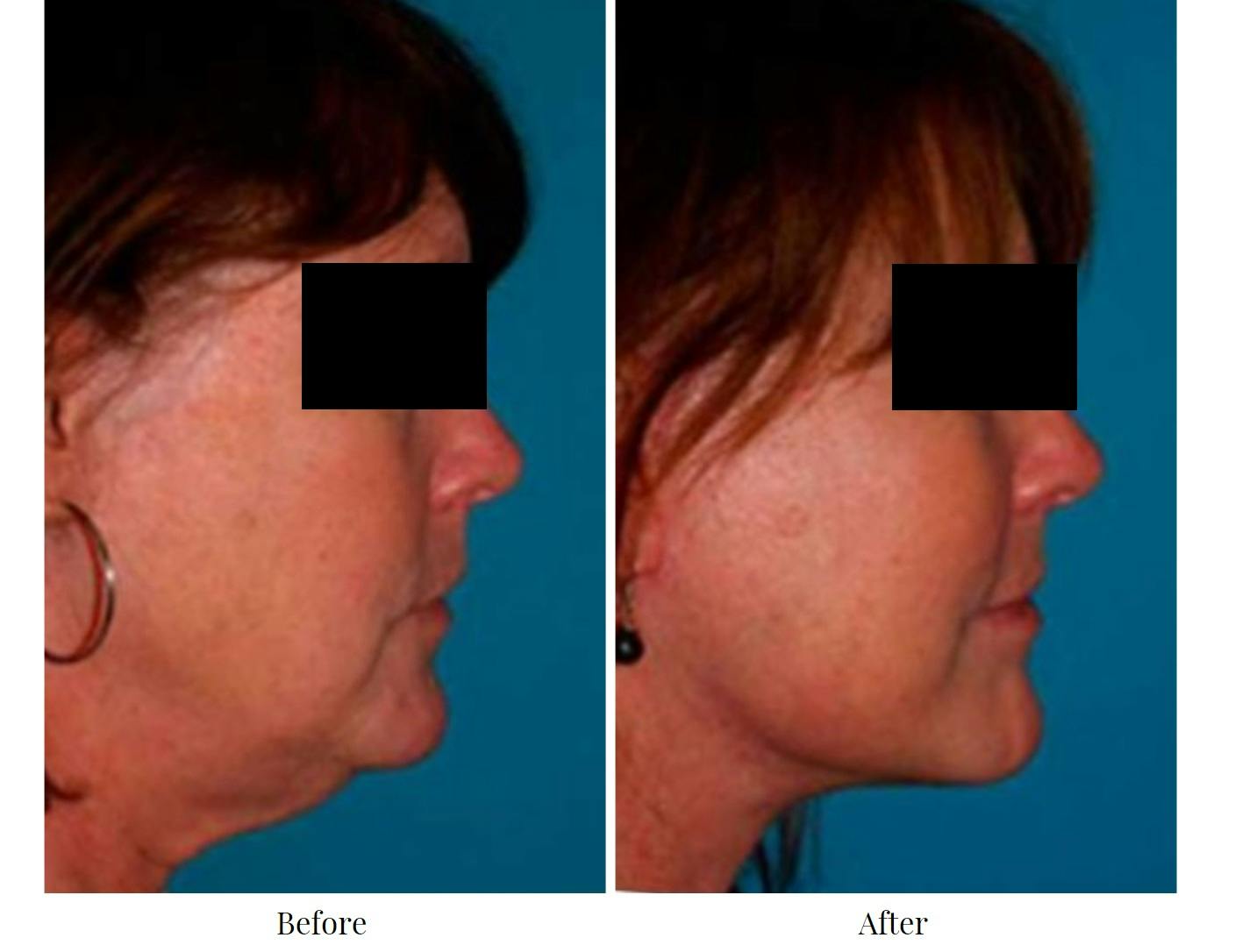 Facelift Before & After Gallery - Patient 64081060 - Image 1