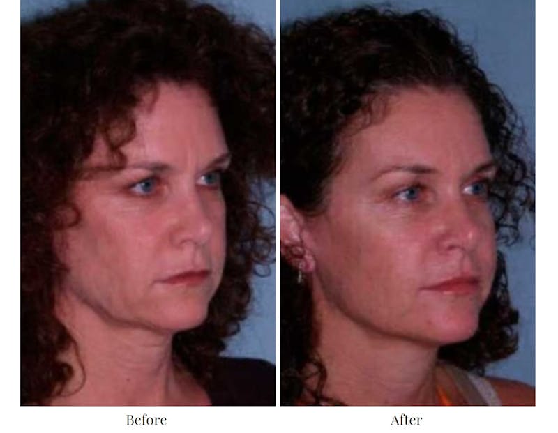 Facelift Before & After Gallery - Patient 64081062 - Image 1