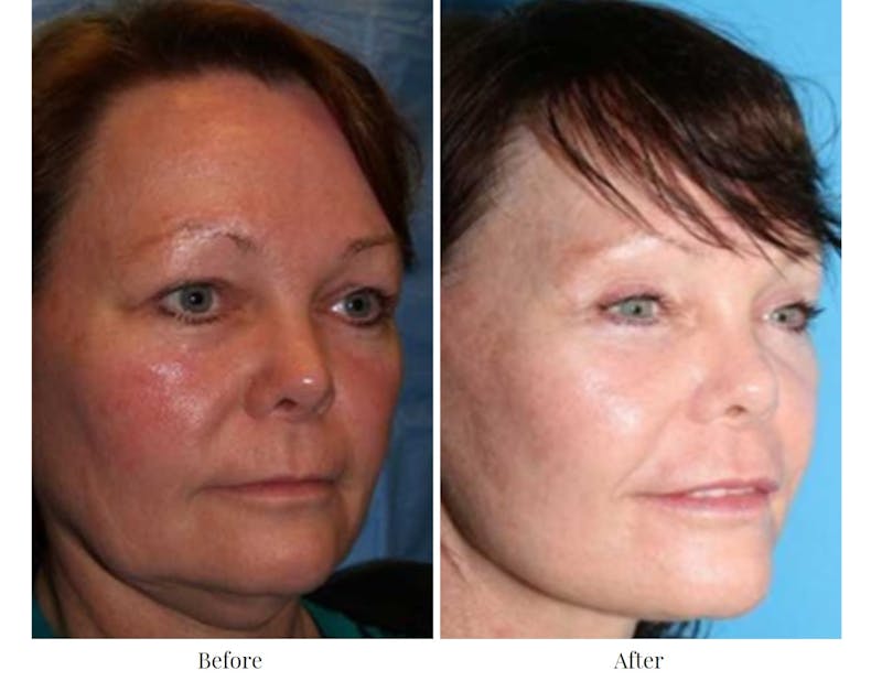Facelift Before & After Gallery - Patient 64081064 - Image 1