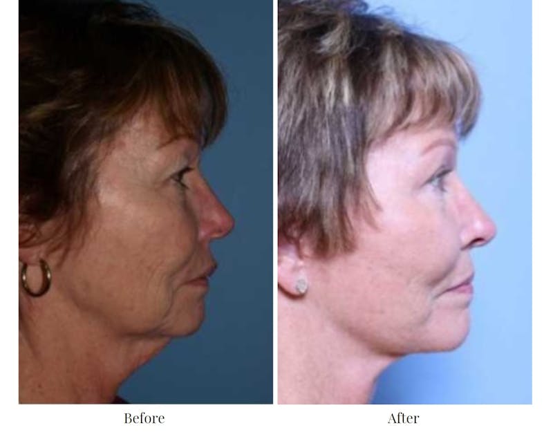 Facelift Before & After Gallery - Patient 64081065 - Image 1