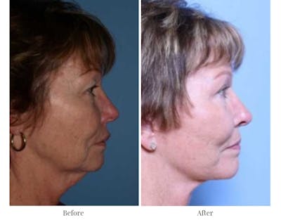 Facelift Before & After Gallery - Patient 64081065 - Image 1