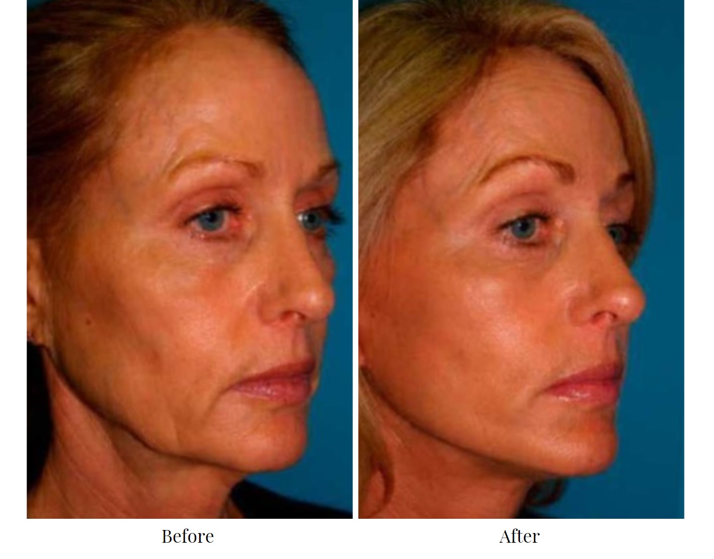 Patient 64081067 Facelift Before & After Photos Gold Coast Plastic