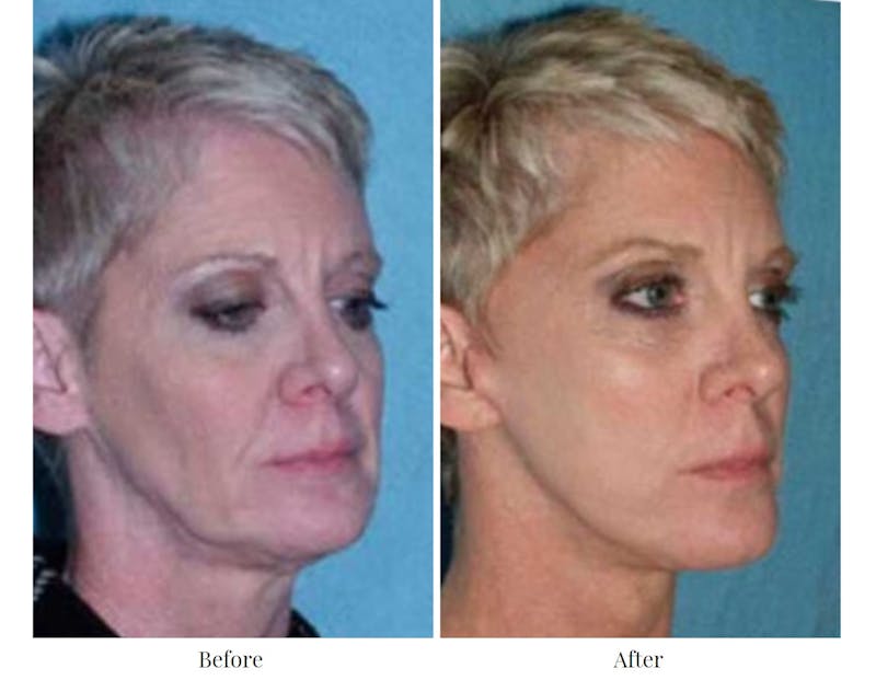 Facelift Before & After Gallery - Patient 64081068 - Image 1