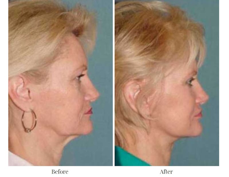 Facelift Before & After Gallery - Patient 64081069 - Image 1