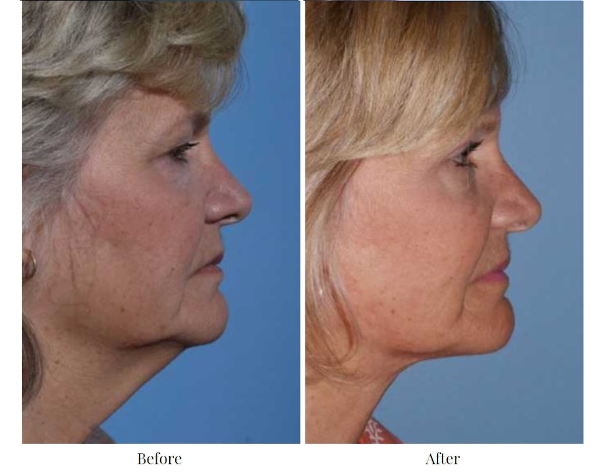 Facelift Before & After Gallery - Patient 64081059 - Image 1