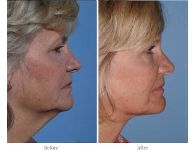 Facelift Before & After Gallery - Patient 64081059 - Image 1