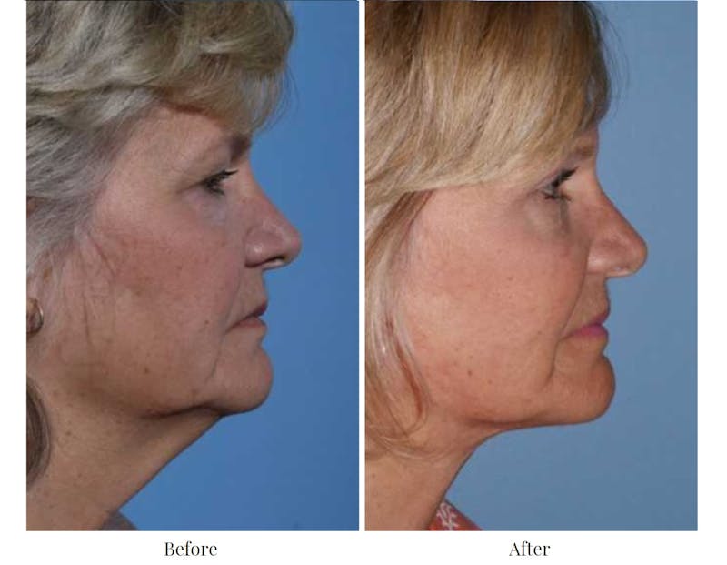 Facelift Before & After Gallery - Patient 64081059 - Image 1