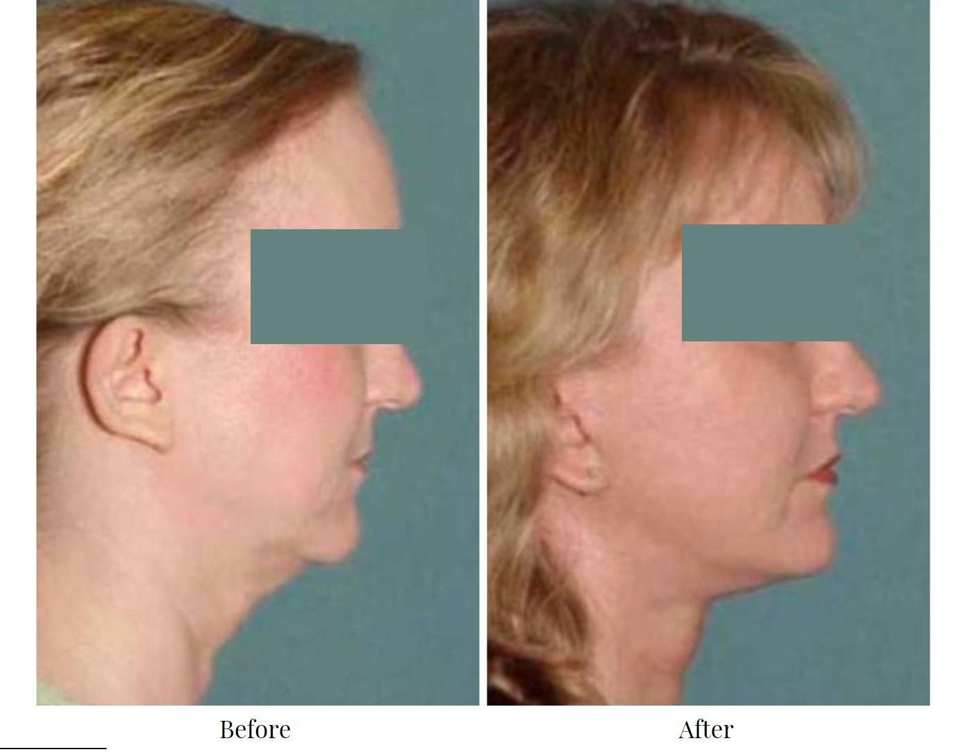 Facelift Before & After Gallery - Patient 64081066 - Image 1