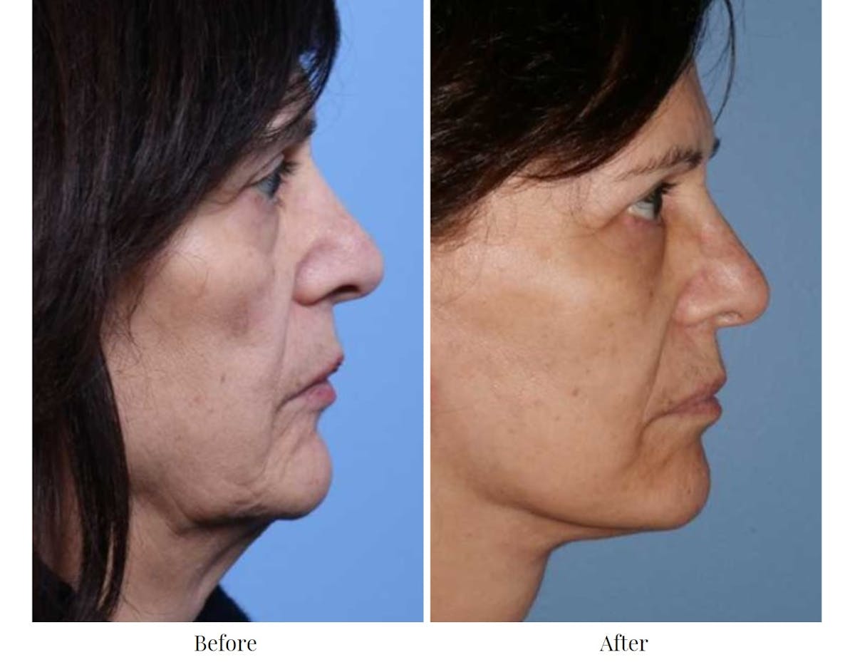 Facelift Before & After Gallery - Patient 64081063 - Image 1