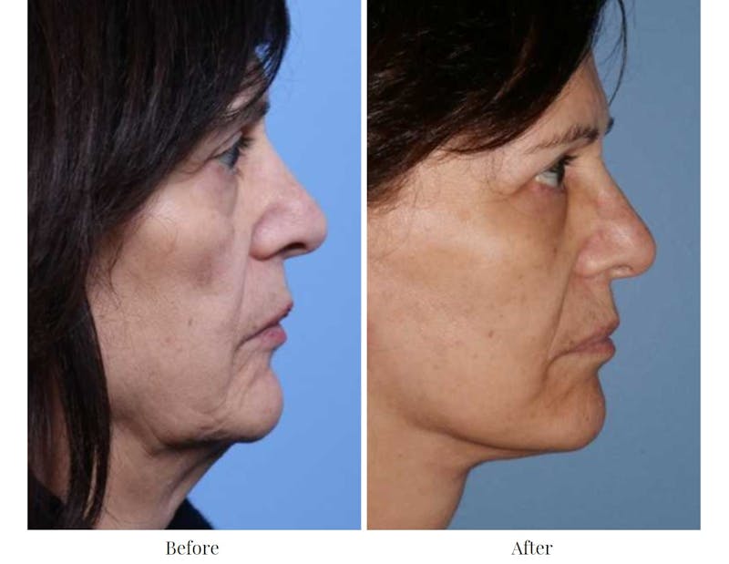 Facelift Before & After Gallery - Patient 64081063 - Image 1