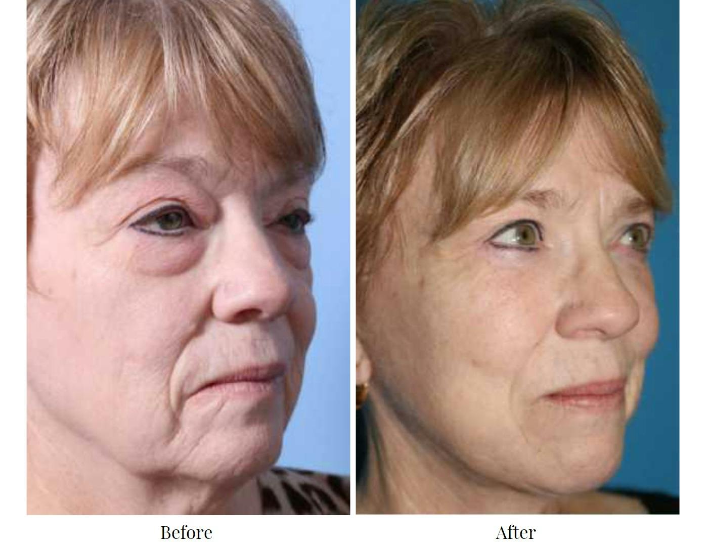Facelift Before & After Gallery - Patient 64081061 - Image 1