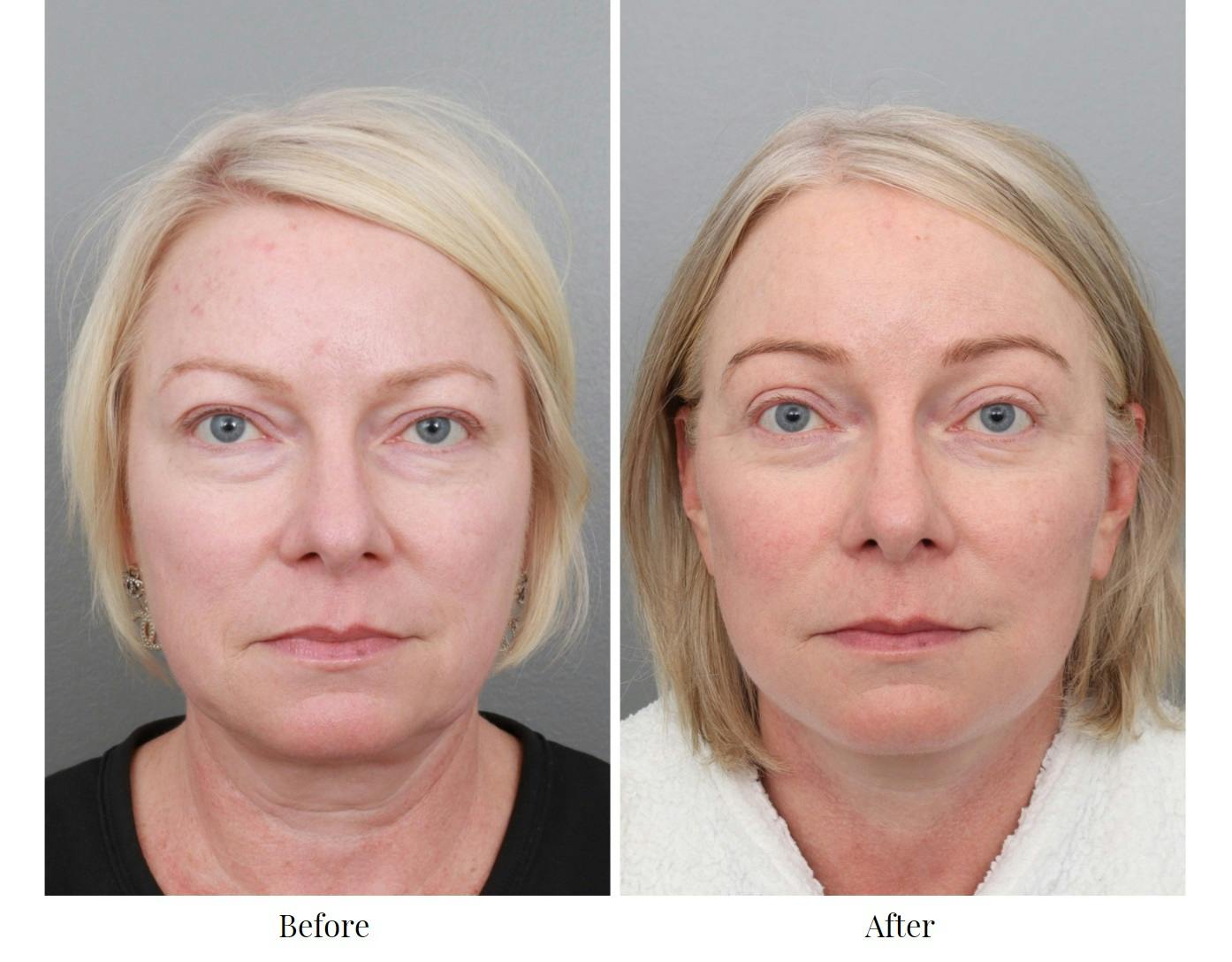 Facelift Before & After Gallery - Patient 70298857 - Image 2