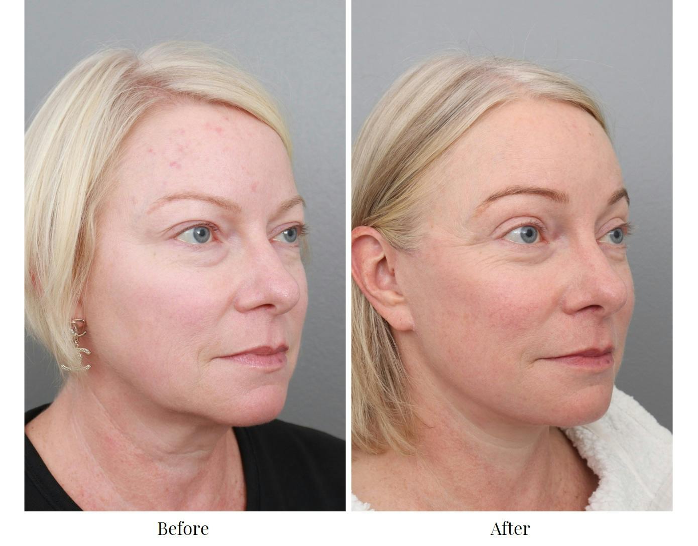 Facelift Before & After Gallery - Patient 70298857 - Image 1