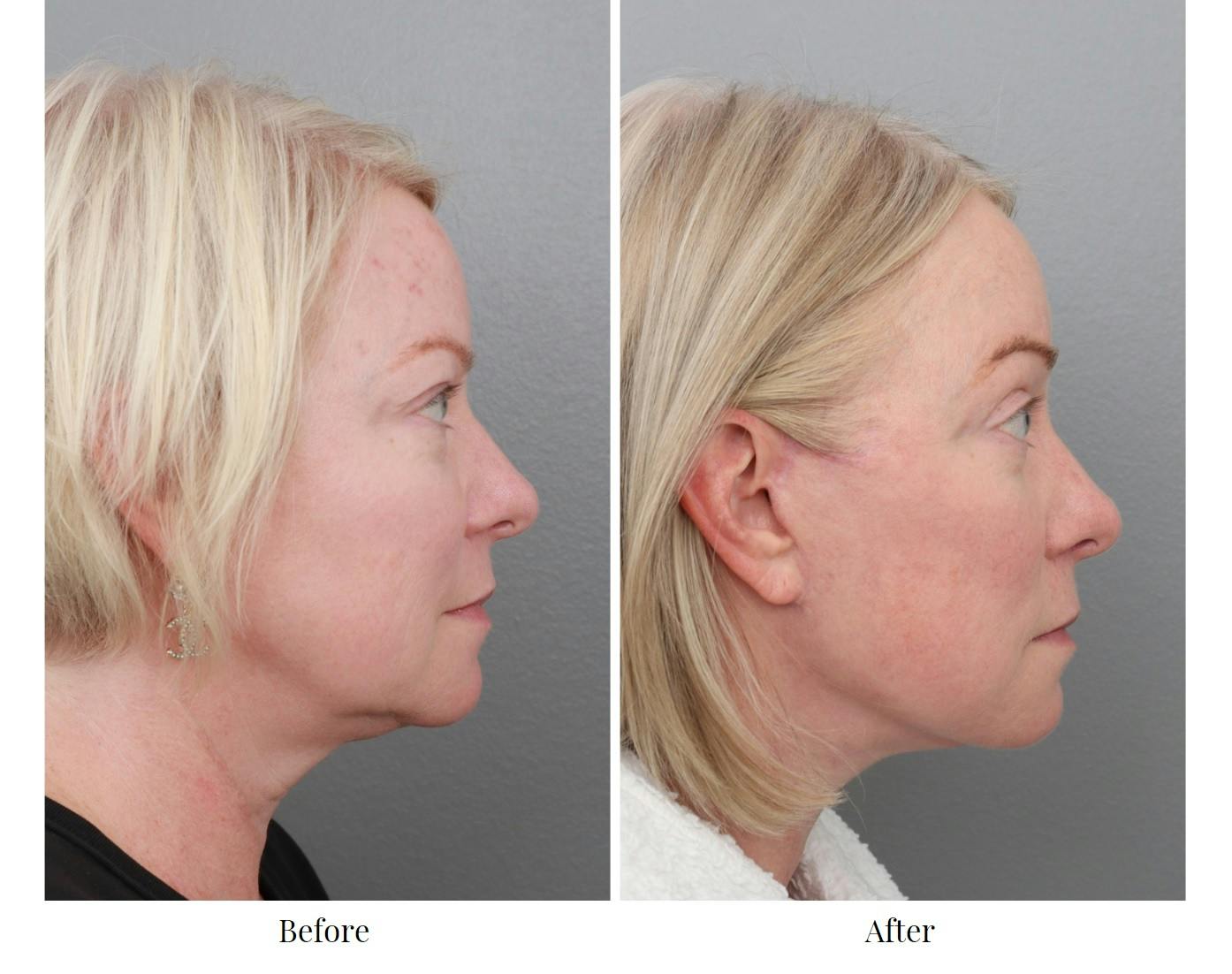Facelift Before & After Gallery - Patient 70298857 - Image 3