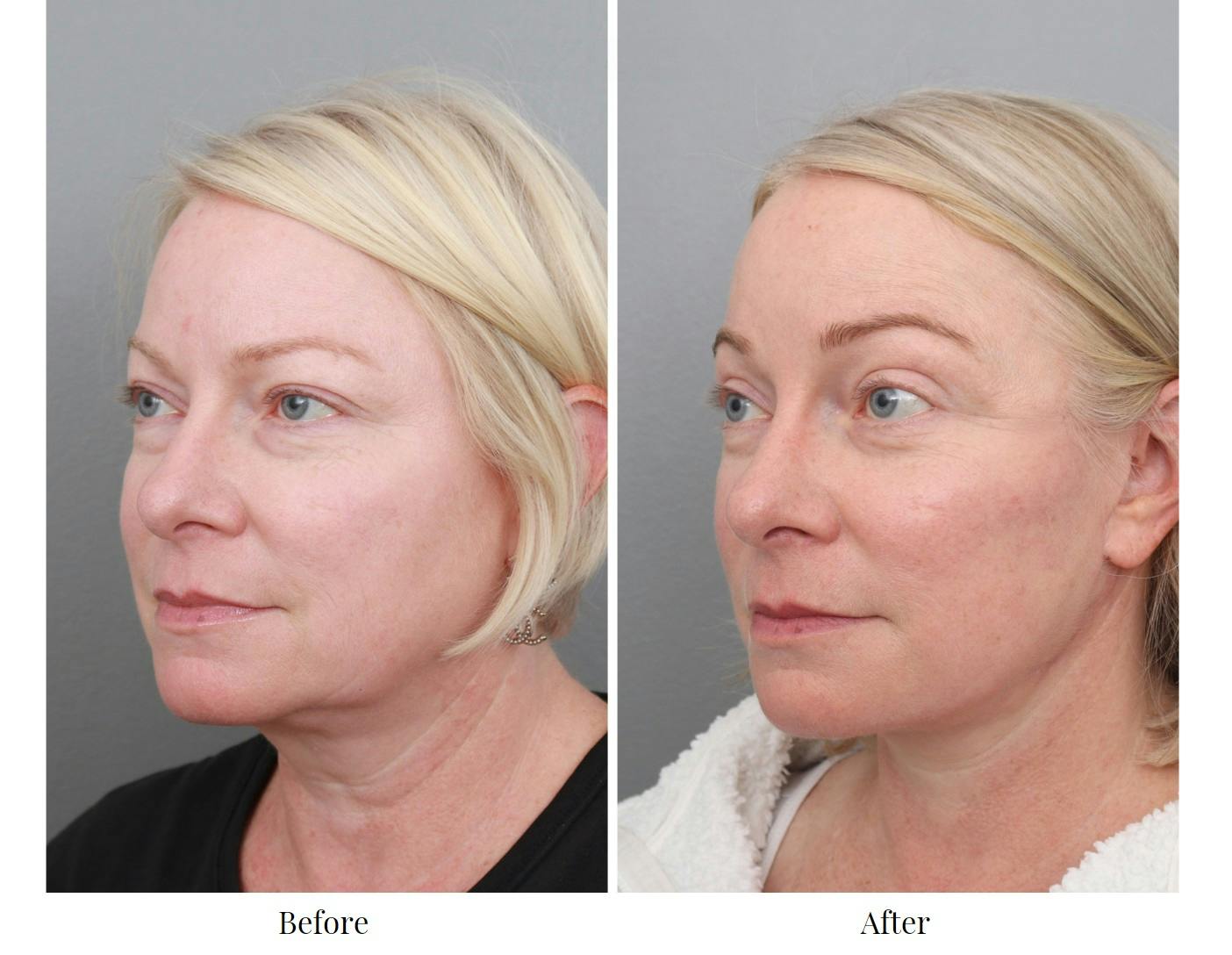 Facelift Before & After Gallery - Patient 70298857 - Image 4
