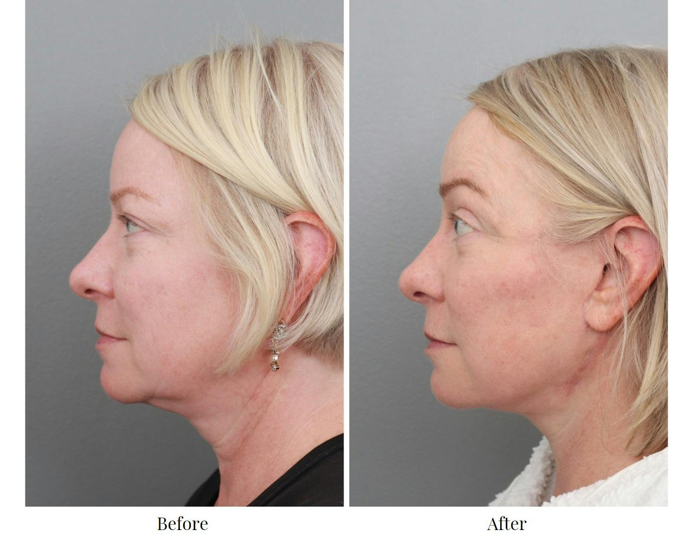 Facelift Before & After Gallery - Patient 70298857 - Image 5