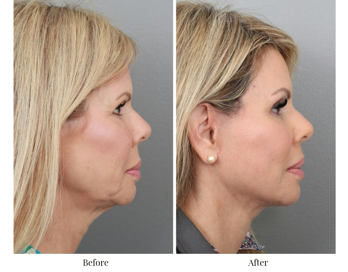 Facelift Before & After Gallery - Patient 64081058 - Image 1