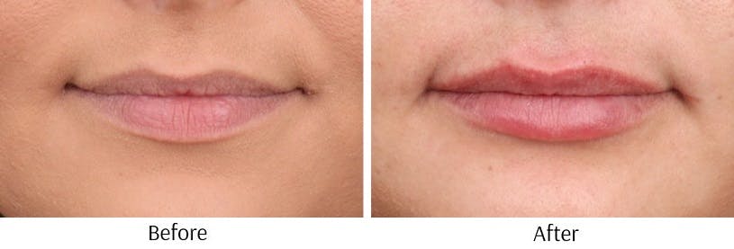 Lip Augmentation Before & After Gallery - Patient 72506057 - Image 1