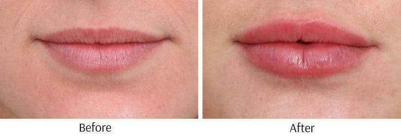 Lip Augmentation Before & After Gallery - Patient 72506056 - Image 1