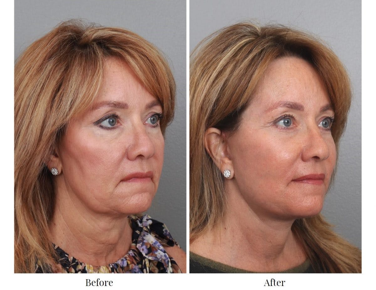 Facelift Before & After Gallery - Patient 64081030 - Image 1
