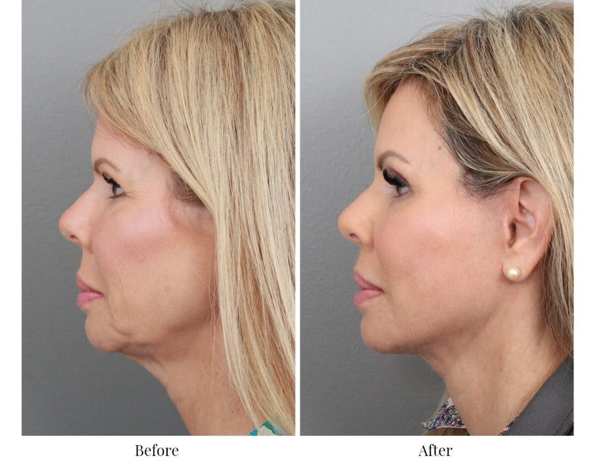 Facelift Before & After Gallery - Patient 64081058 - Image 2
