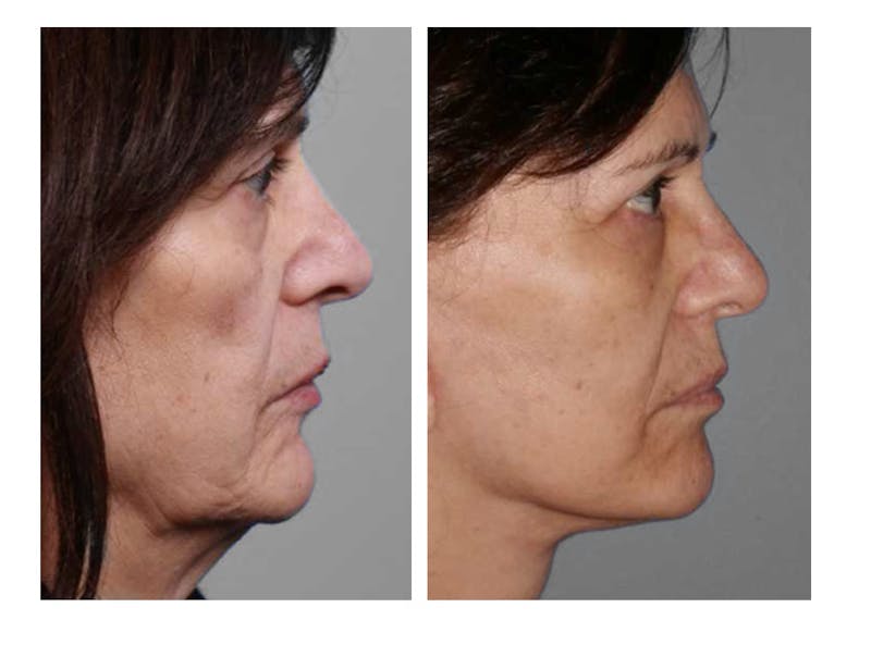 Facelift Before & After Gallery - Patient 64081063 - Image 1