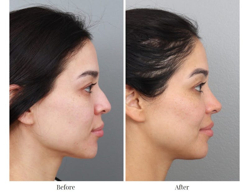 Rhinoplasty Before & After Gallery - Patient 64080954 - Image 1