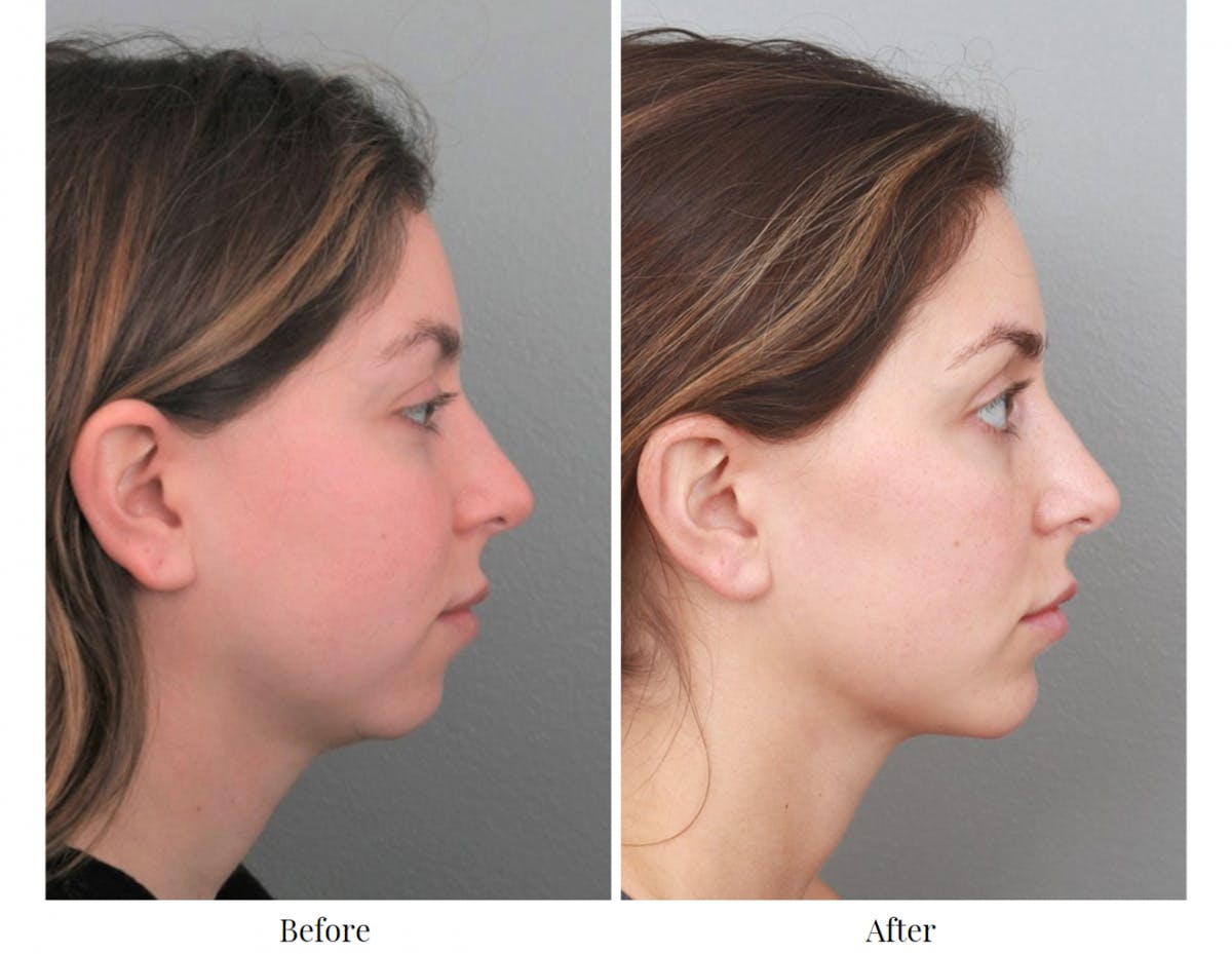 Chin Augmentation Before & After Gallery - Patient 64081117 - Image 1
