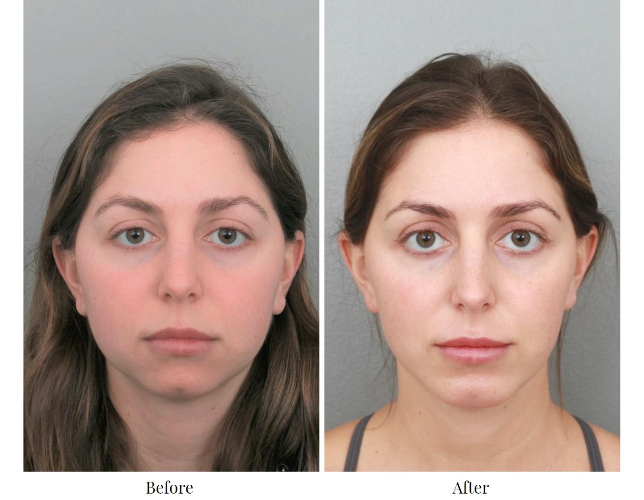 Chin Augmentation Before & After Gallery - Patient 64081117 - Image 4