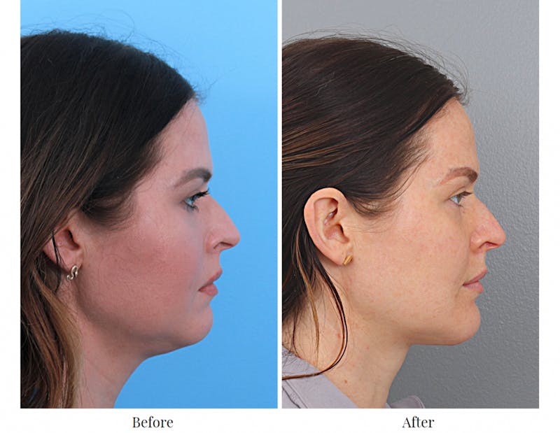 Chin Augmentation Before & After Gallery - Patient 64081127 - Image 1